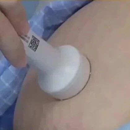 40岁女子怀孕后，胎儿在子宫消失，竟寄生在母亲肝脏上！医生：肝脏妊娠病死率为宫内孕90倍